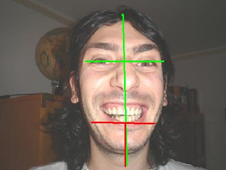con bite muscolatura in tensione in asse.JPG